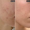 Mandelic Acid Spot Treatment