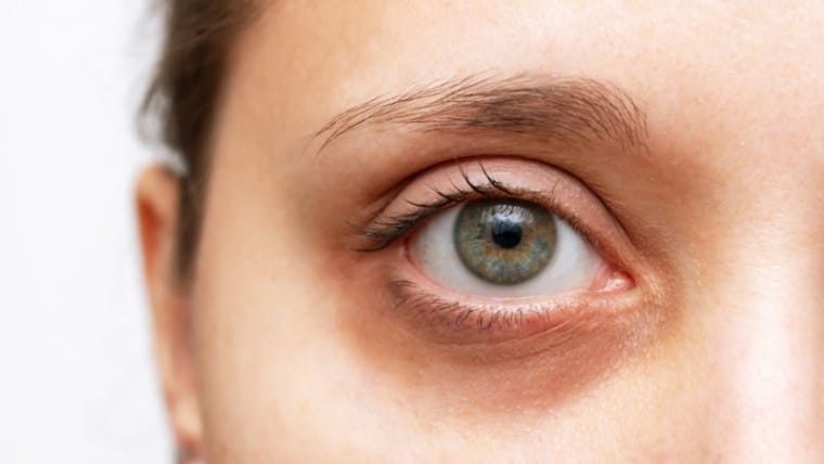 Dark Circles and How to Treat them